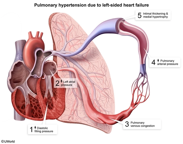 Ambrisentan: A Breakthrough Treatment for Pulmonary Arterial Hypertension